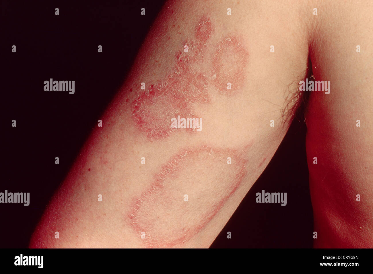 Urticarias fotografías e imágenes de alta resolución Alamy