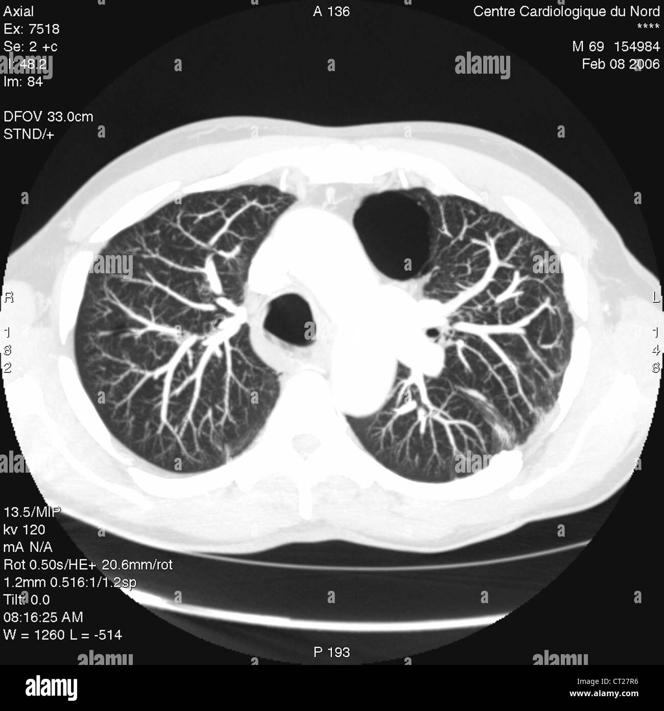 Enfisema bulloso, Lung Scan Fotografía de stock - Alamy