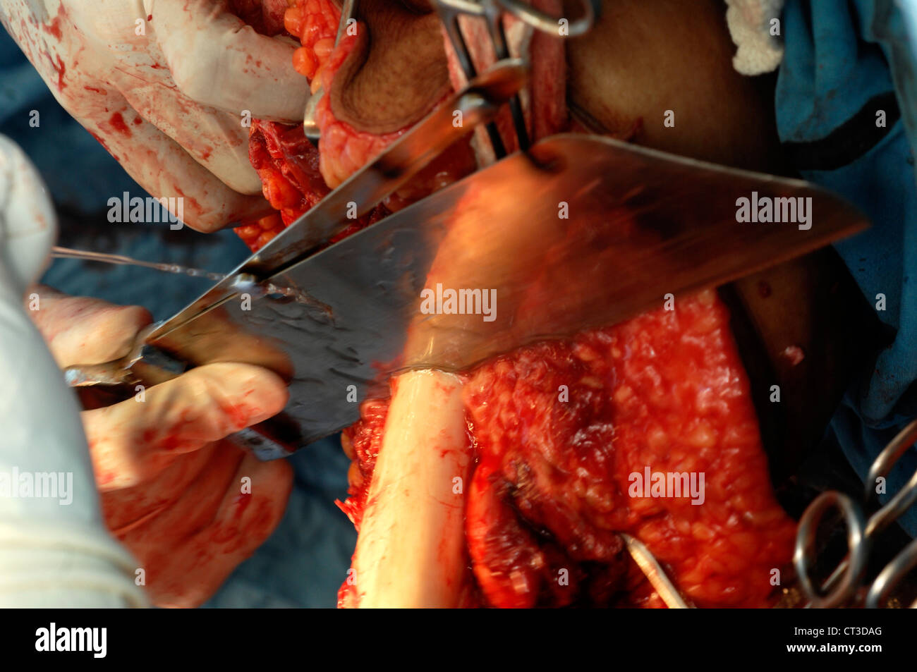 Los cirujanos regar la hoja durante una amputación de la pierna para quitar cualquier fragmentos de hueso contra la cuchilla. Foto de stock