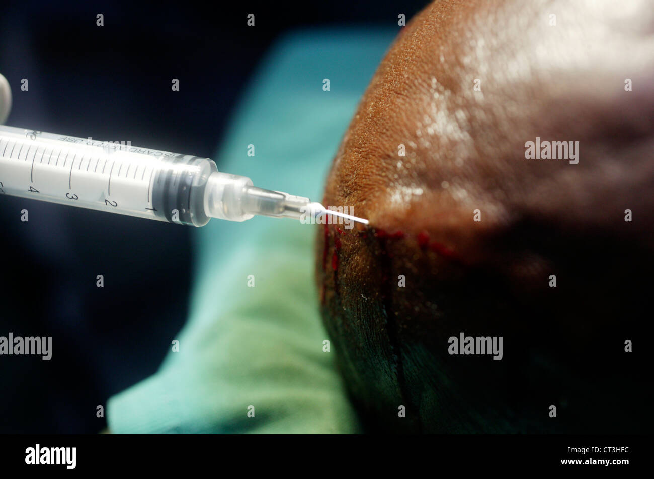 Un cirujano inyecta un cuero cabelludo del paciente con anestésico local y adrenalina, antes de hacer una incisión. Foto de stock