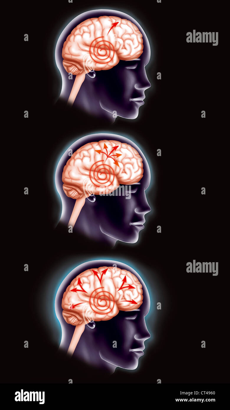 Epilepsia Dibujo} Fotografías E Imágenes De Alta Resolución Alamy