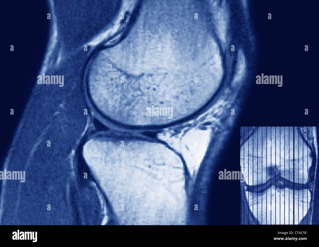 Resonancia magnética de la rodilla fotografías e imágenes de alta  resolución - Alamy