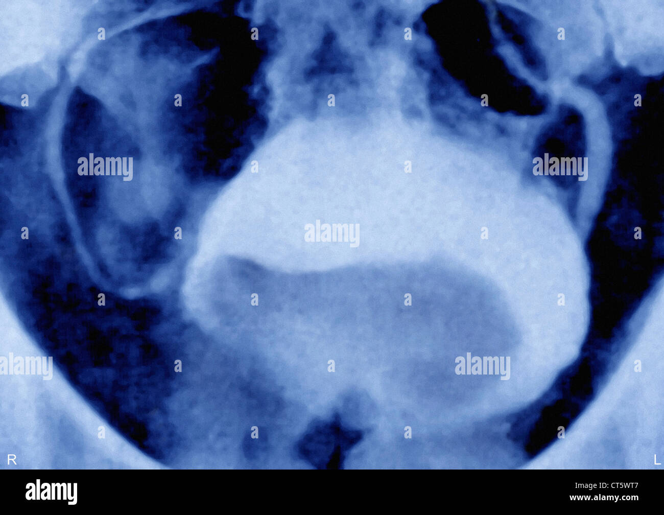 ADENOMA prostático, rayos X Foto de stock