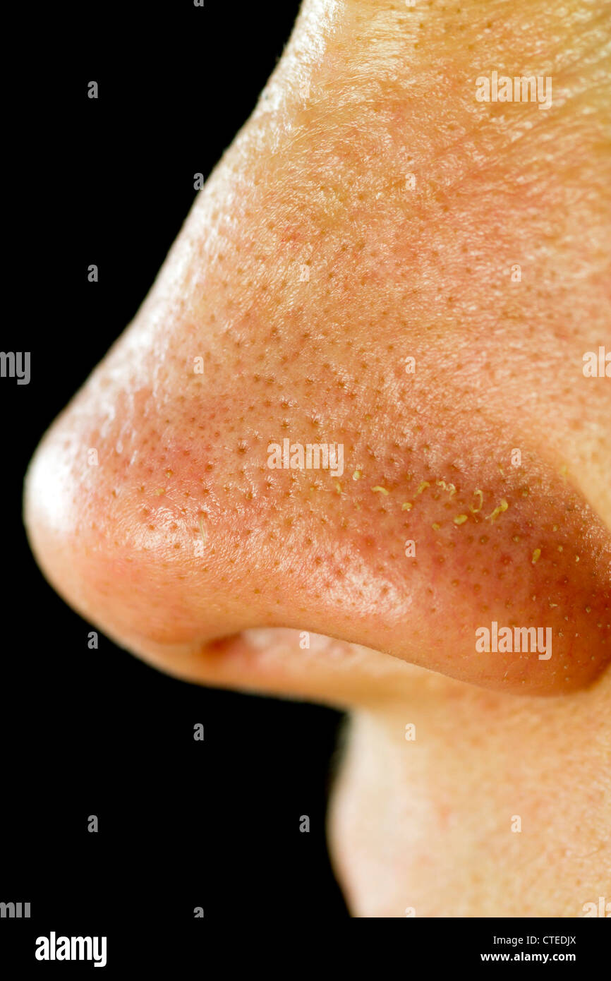 La mujer nariz grasos poros Foto de stock