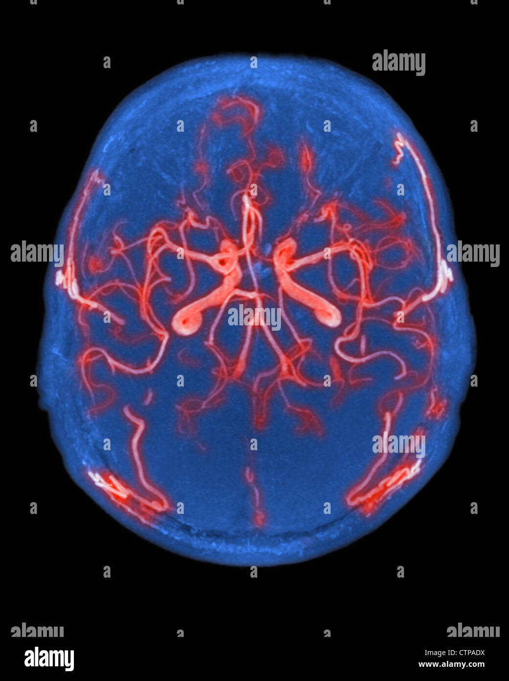 Normal abastecimiento de sangre arterial al cerebro Foto de stock
