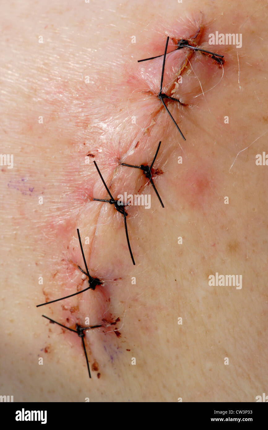 Una incisión quirúrgica de la herida de la cirugía del hombro del manguito de los rotadores de Victoria, British Columbia, Canadá. Foto de stock