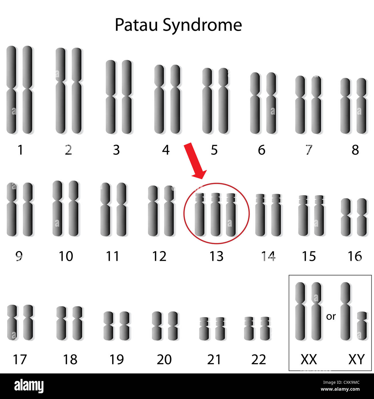El síndrome de Patau, trisomía 13 Foto de stock
