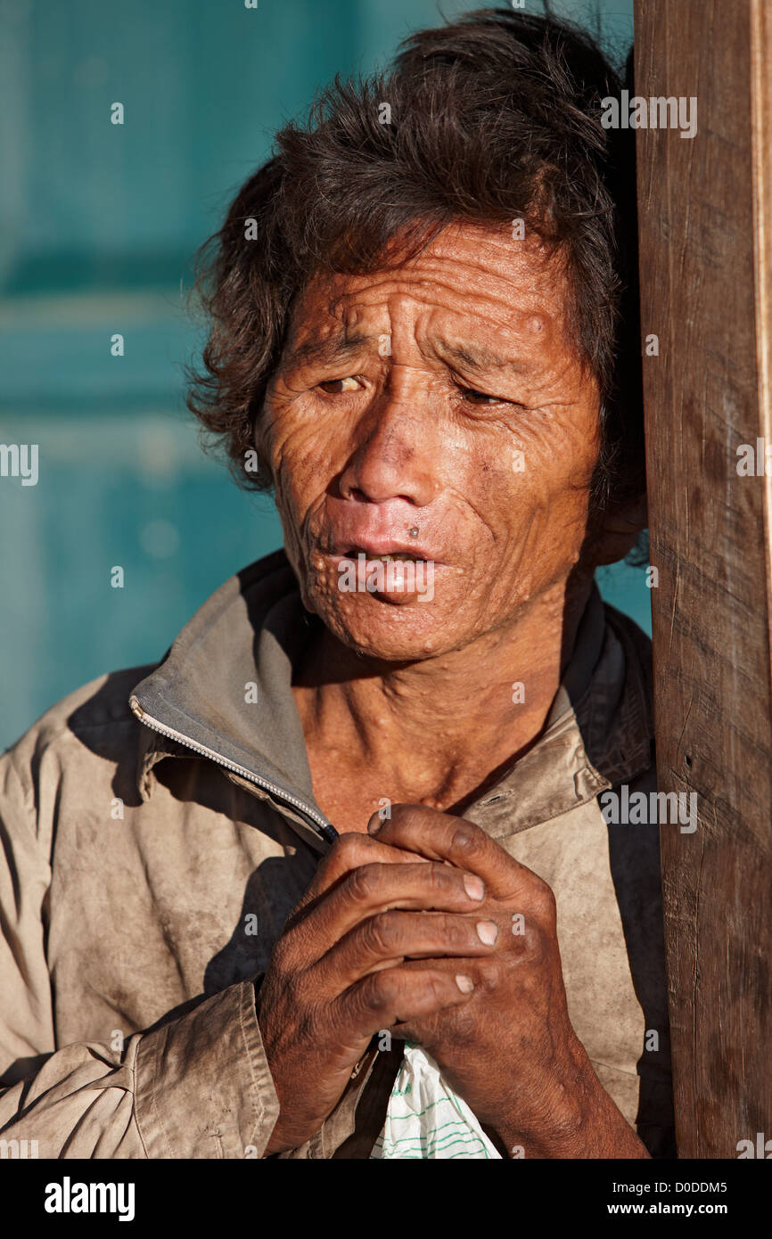 Un hombre con un grave trastorno dermatológico en Num Village, la región oriental de Nepal. Foto de stock