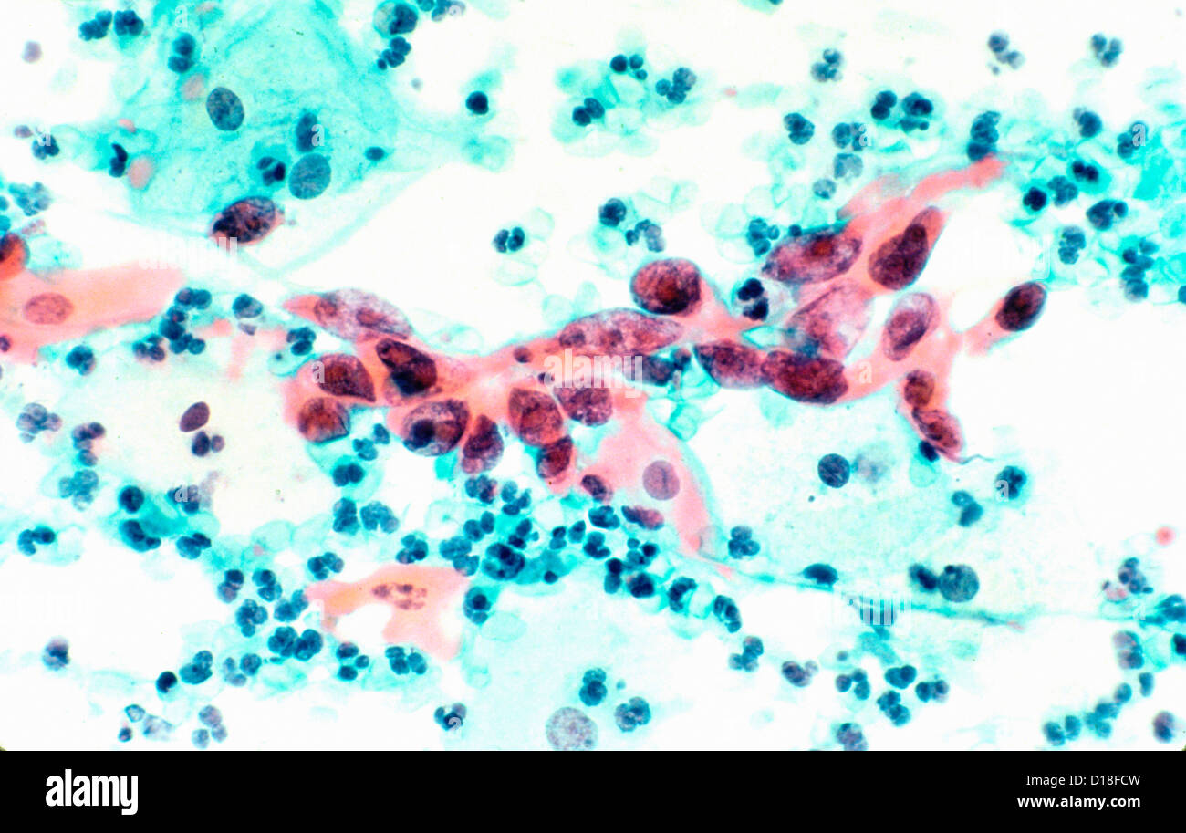 Microfotografía, el carcinoma de células escamosas del cuello uterino Foto de stock
