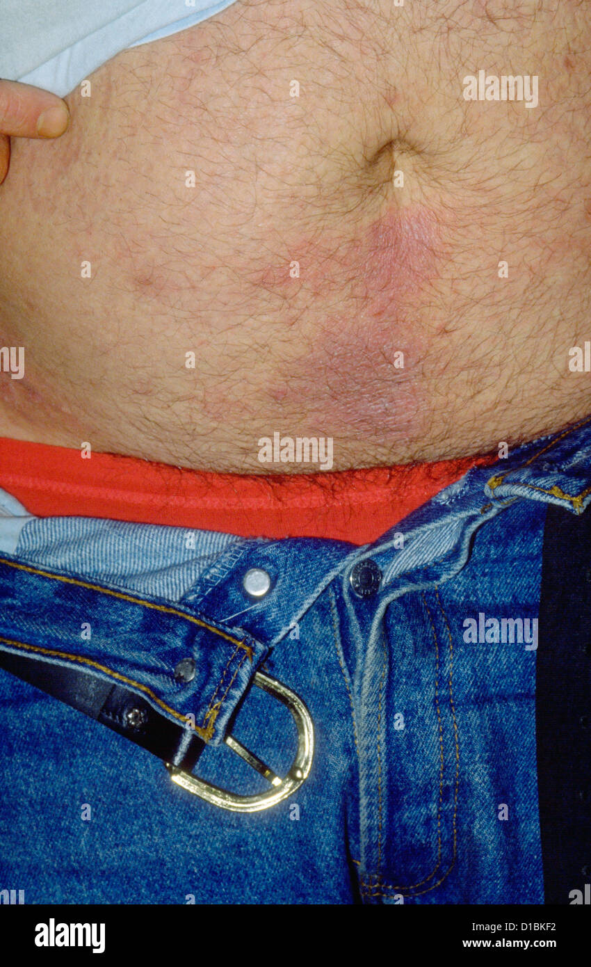 Alergia al níquel fotografías e imágenes de alta resolución - Alamy