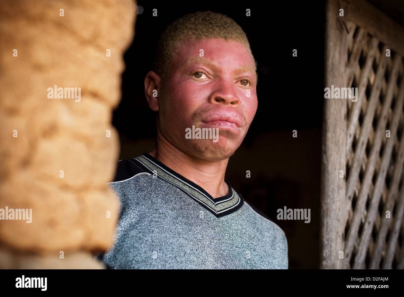 Hombre albino africano con quemaduras en su rostro. Foto de stock