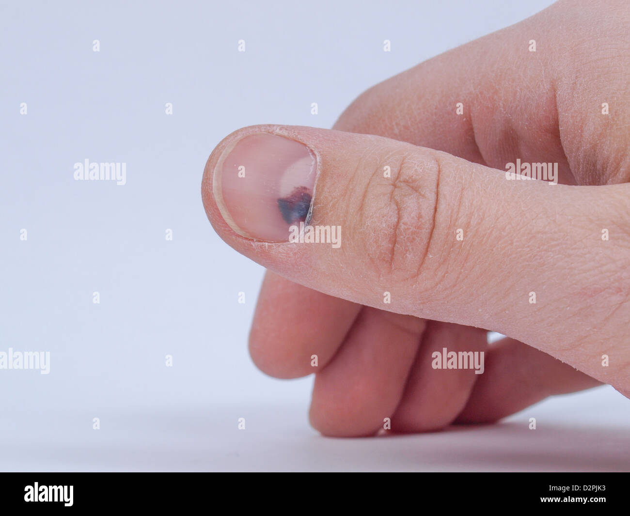 Subungual hematoma fotografías e imágenes de alta resolución Alamy