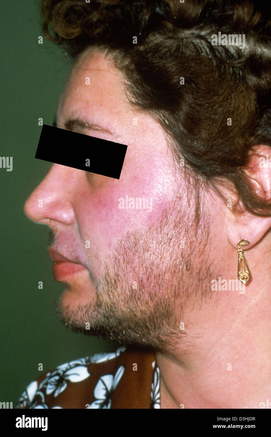 HIRSUTISMO Fotografía de stock Alamy