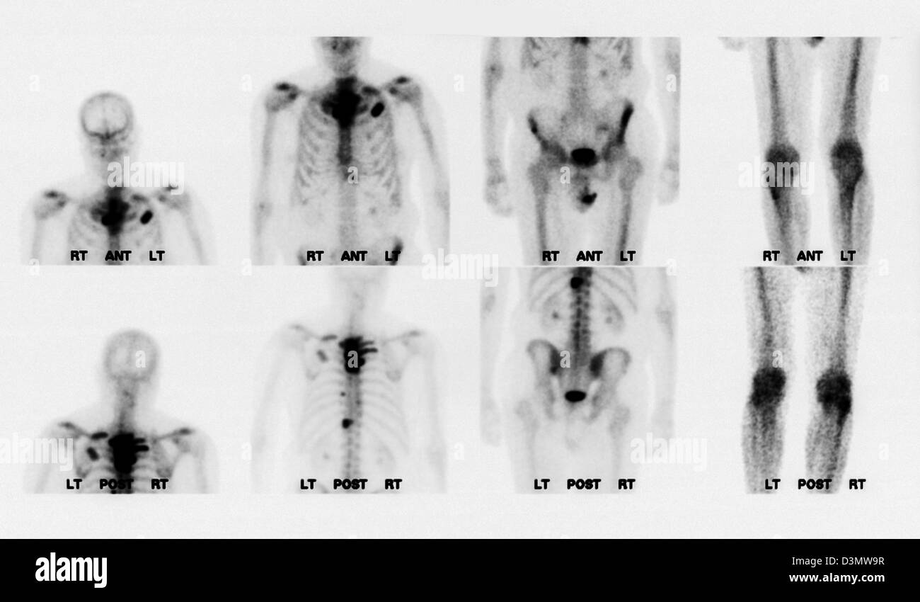 Gammagrafía ósea que muestra metástasis múltiples Foto de stock