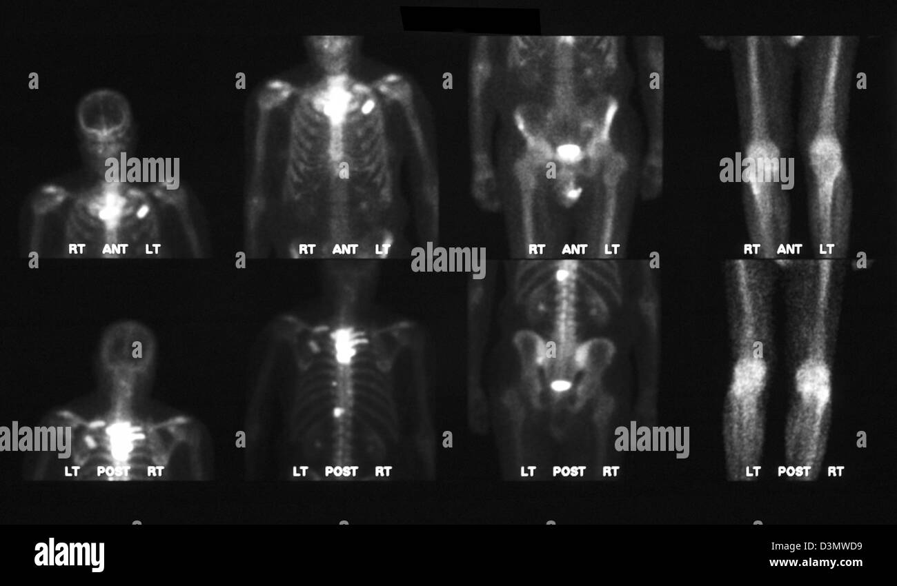Gammagrafía ósea que muestra metástasis múltiples Foto de stock