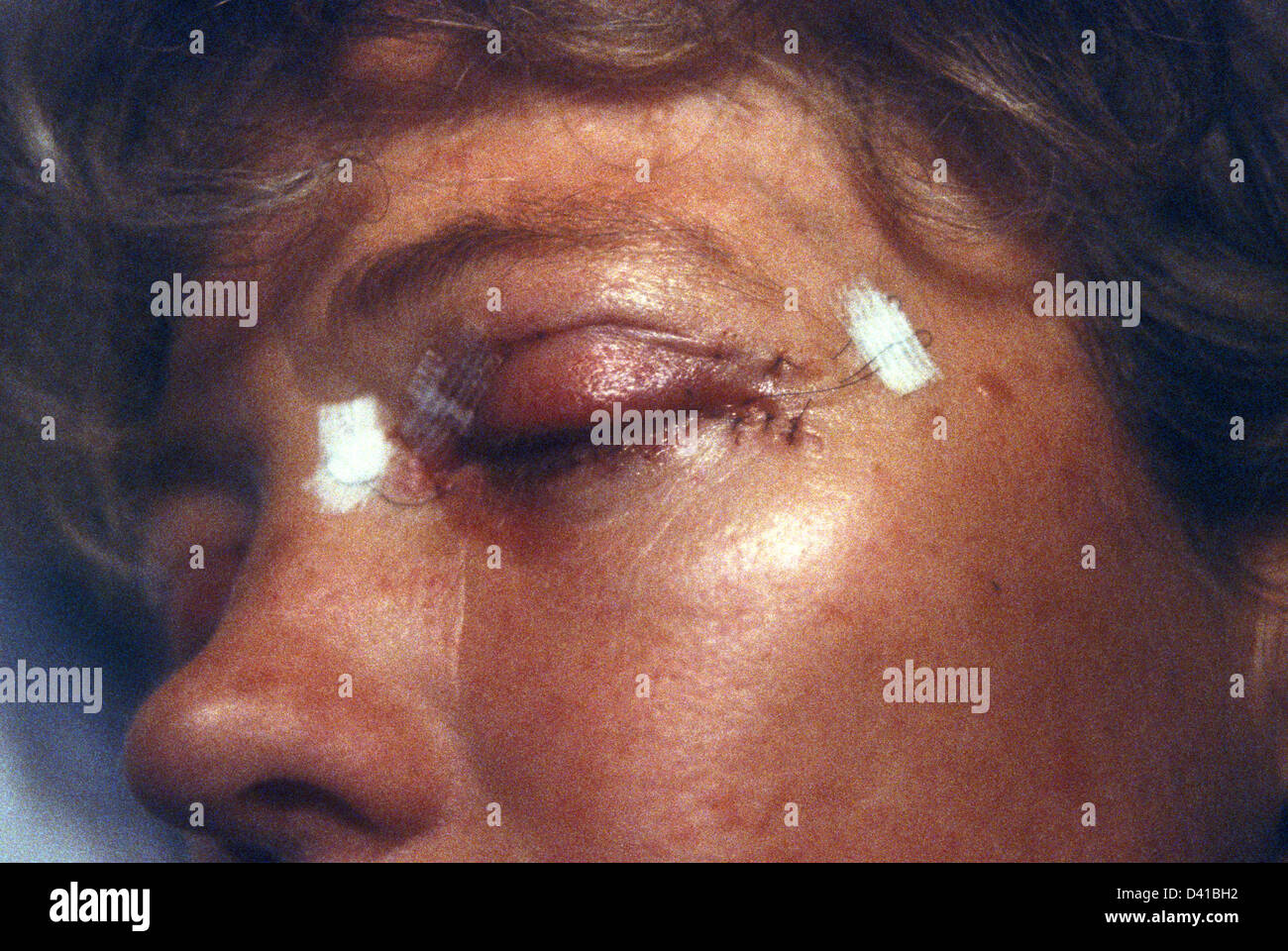 Cirugía posoperatoria del ojo para tapas flagadas, mujer, Londres Foto de stock