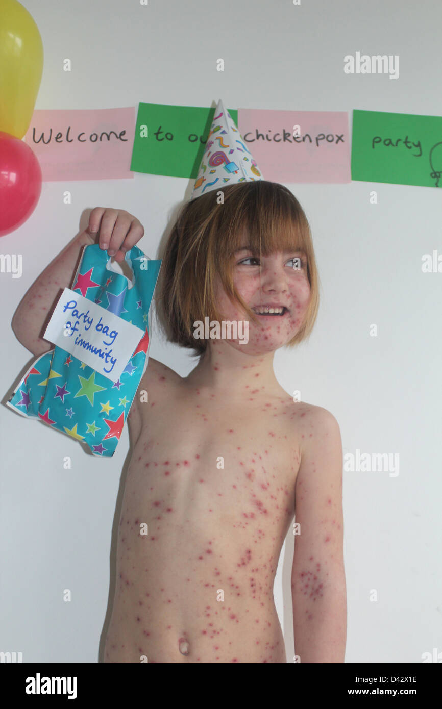 Un niño que tiene varicela parte Foto de stock