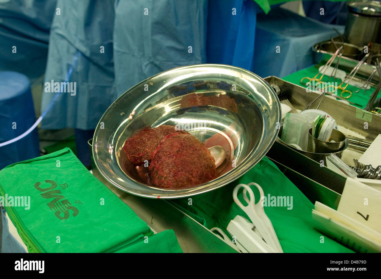 Hígado enfermo en plata plato después del transplante de hígado. Foto de stock