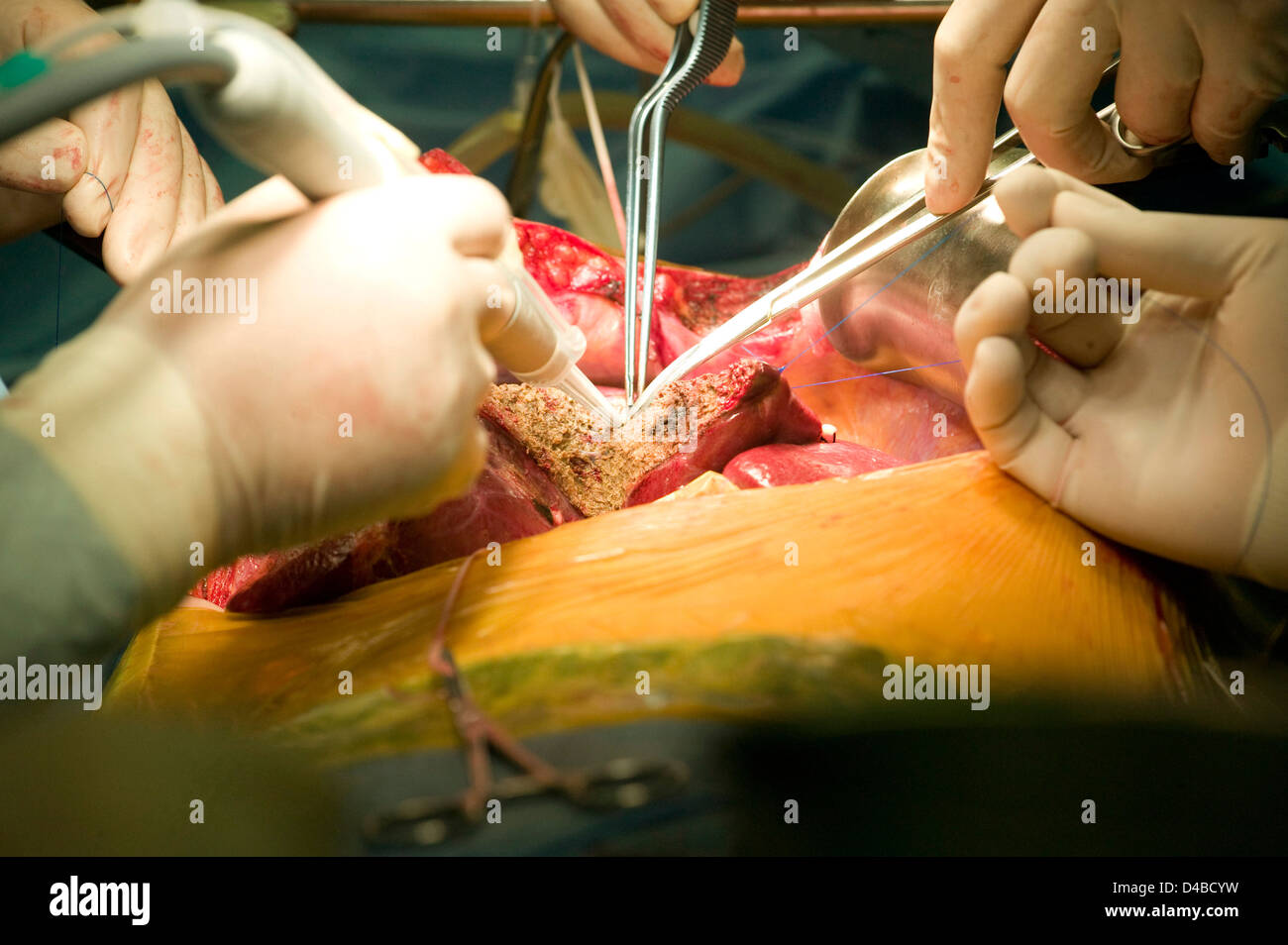 Los cirujanos que realizan un trasplante de hígado en el Centro Médico Samsung. Foto de stock