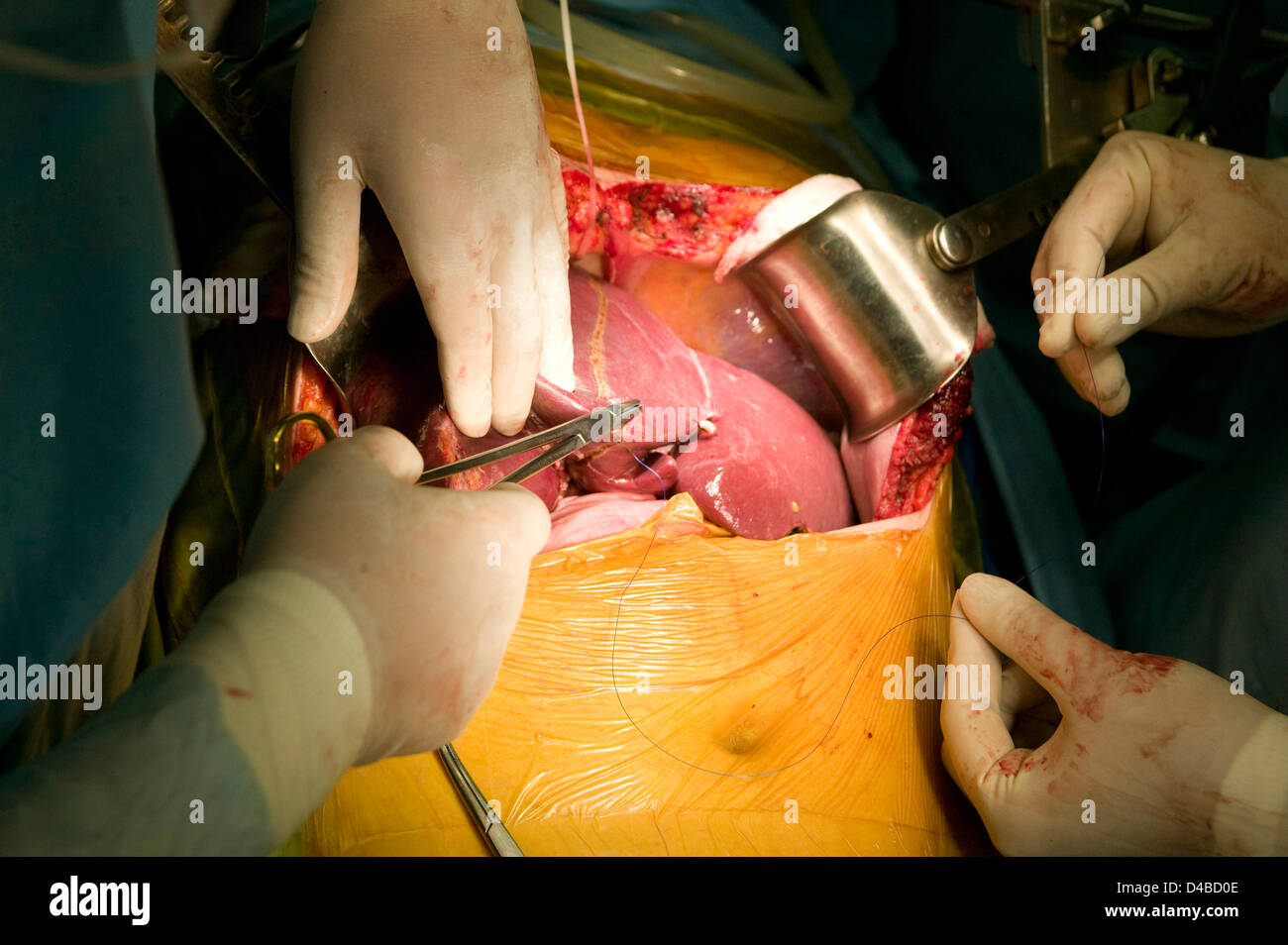 Los cirujanos que realizan un trasplante de hígado en el Centro Médico Samsung. Foto de stock