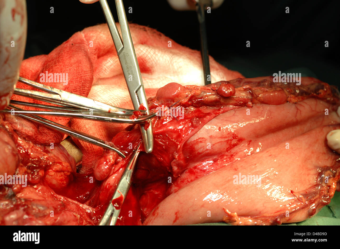 Las abrazaderas de la arteria cerca de oclusión de los vasos sanguíneos pequeños Foto de stock