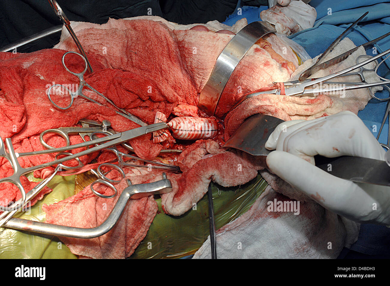 Los cirujanos completando con anastomosis proximal sujetada injerto distalmente Foto de stock