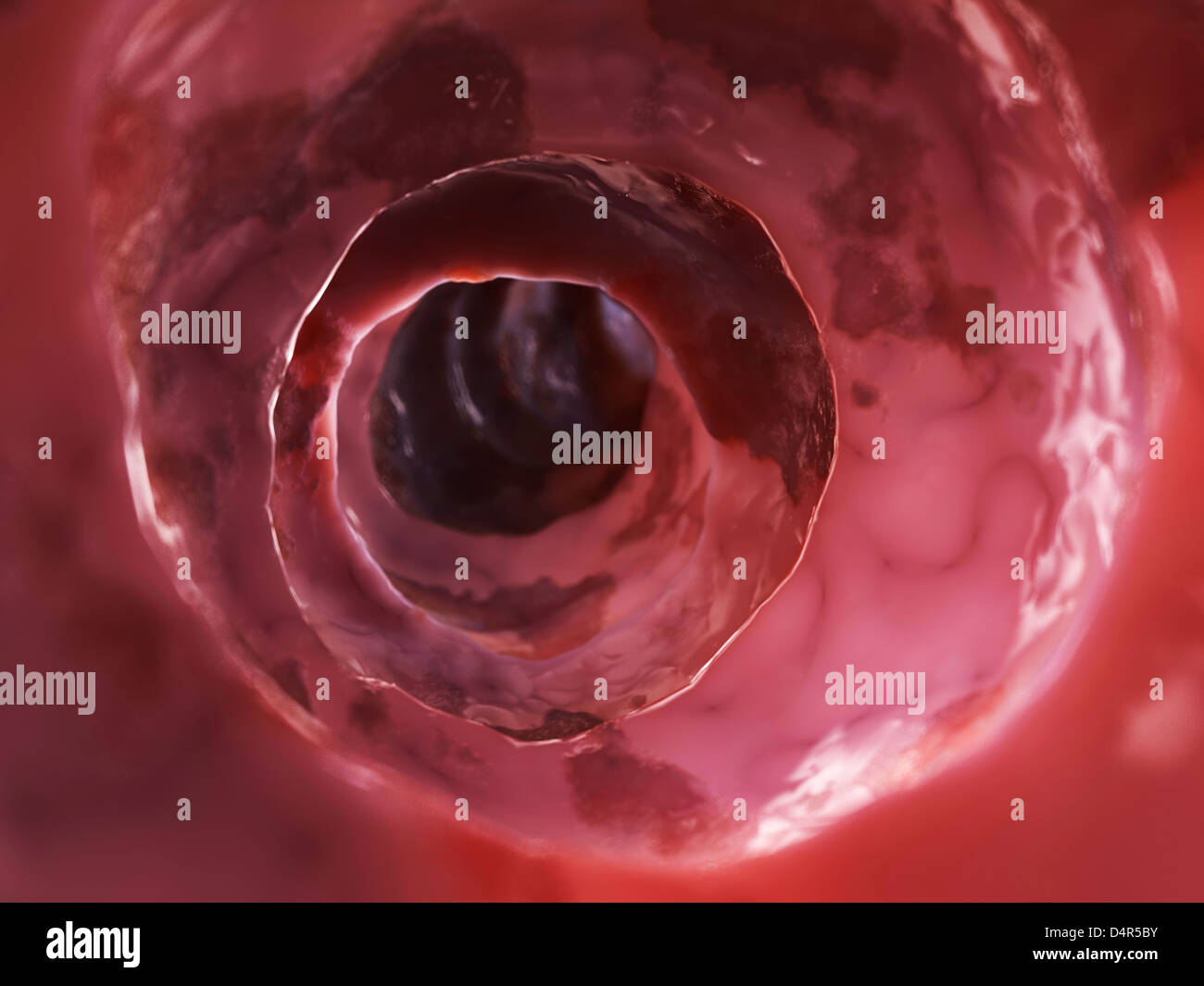 En el interior de un colon insalubre Foto de stock