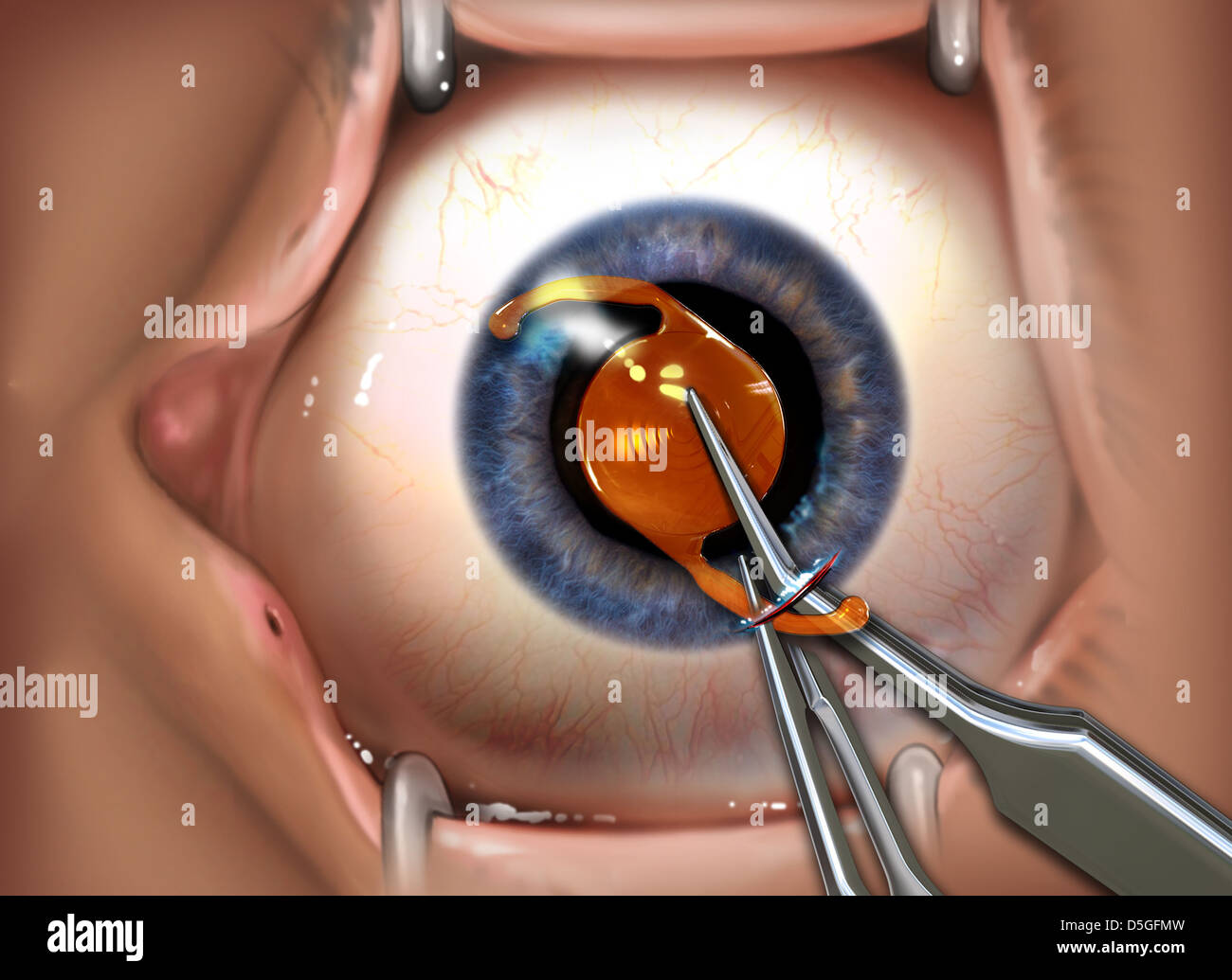 Ashley Furman Sur oeste Decepción Lente intraocular fotografías e imágenes de alta resolución - Alamy Ashley Furman Sur oeste Decepción Lente intraocular fotografías e imágenes de alta resolución - Alamy