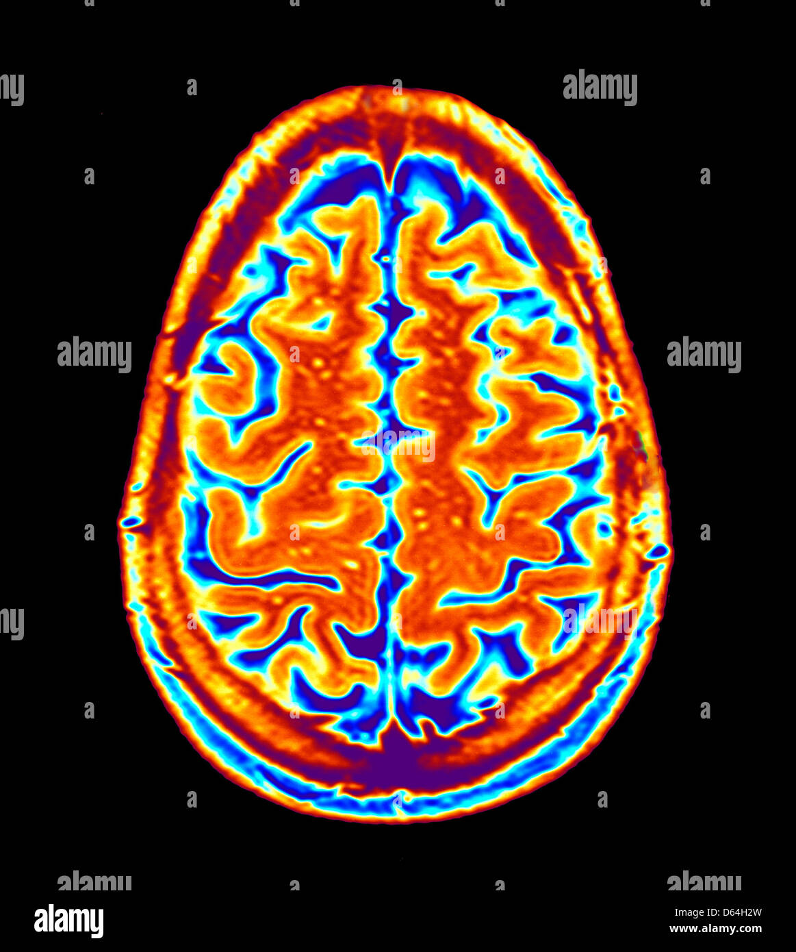 Gammagrafía cerebral, resonancia magnética Foto de stock