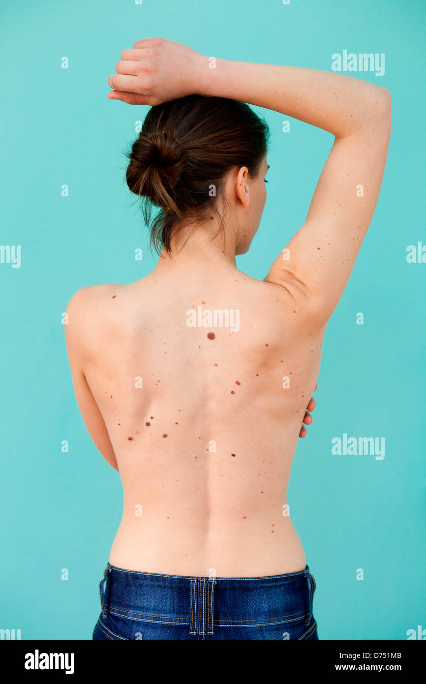 Los lunares en la espalda de una mujer Fotografía de stock - Alamy