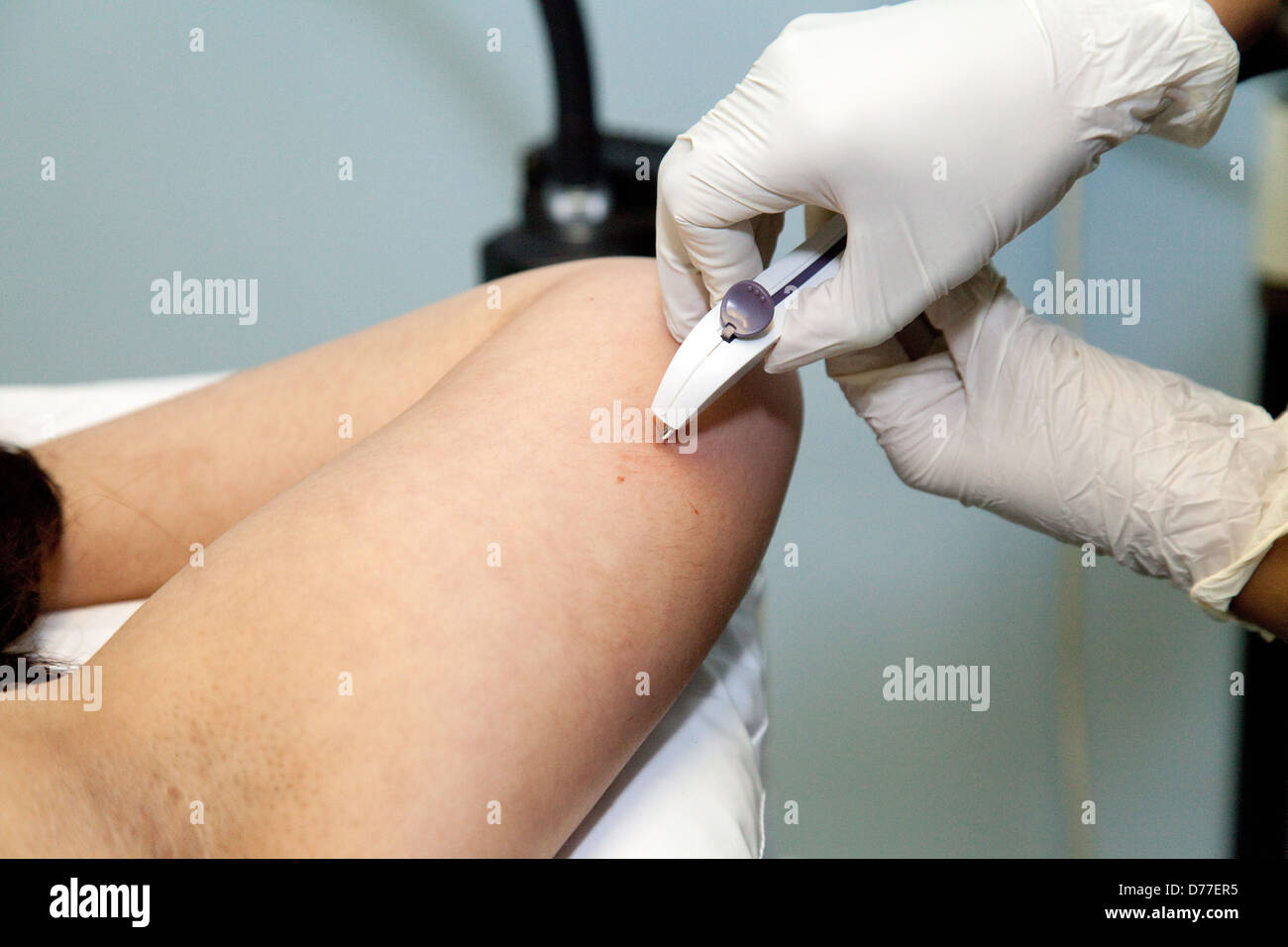 Una mujer tiene un implante anticonceptivo a largo plazo Nexplanon puesta en su brazo, Suffolk, Reino Unido Foto de stock