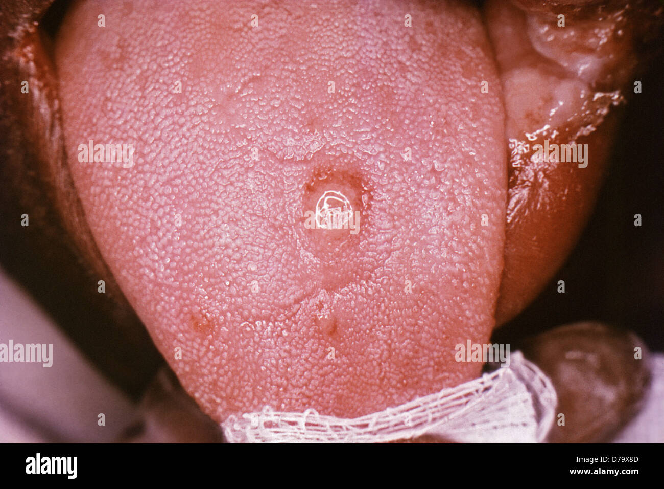 Sífilis primaria fotografías e imágenes de alta resolución - Alamy