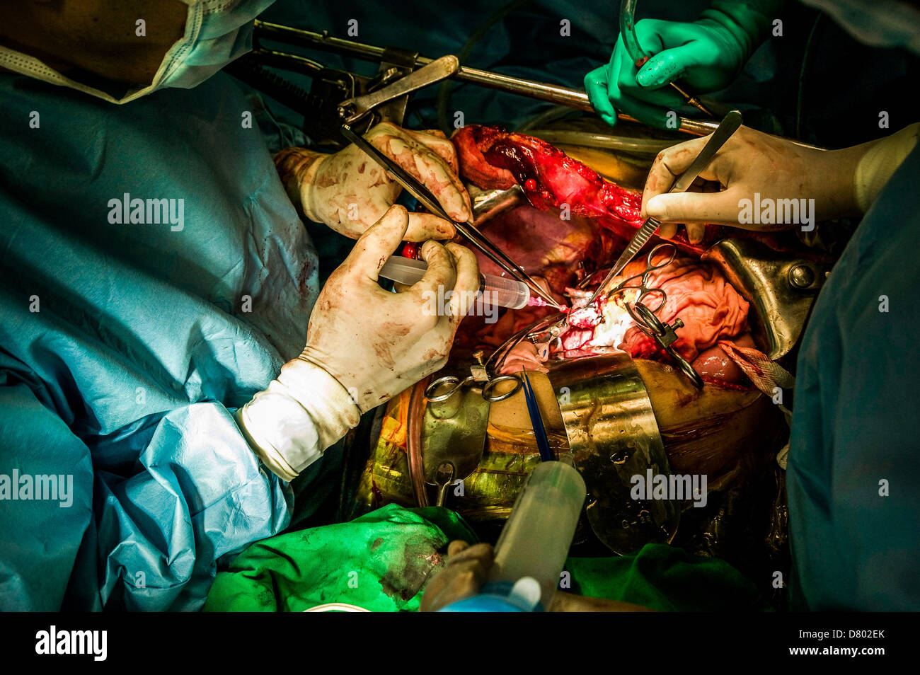 Los cirujanos que realizan un trasplante de hígado. Foto de stock
