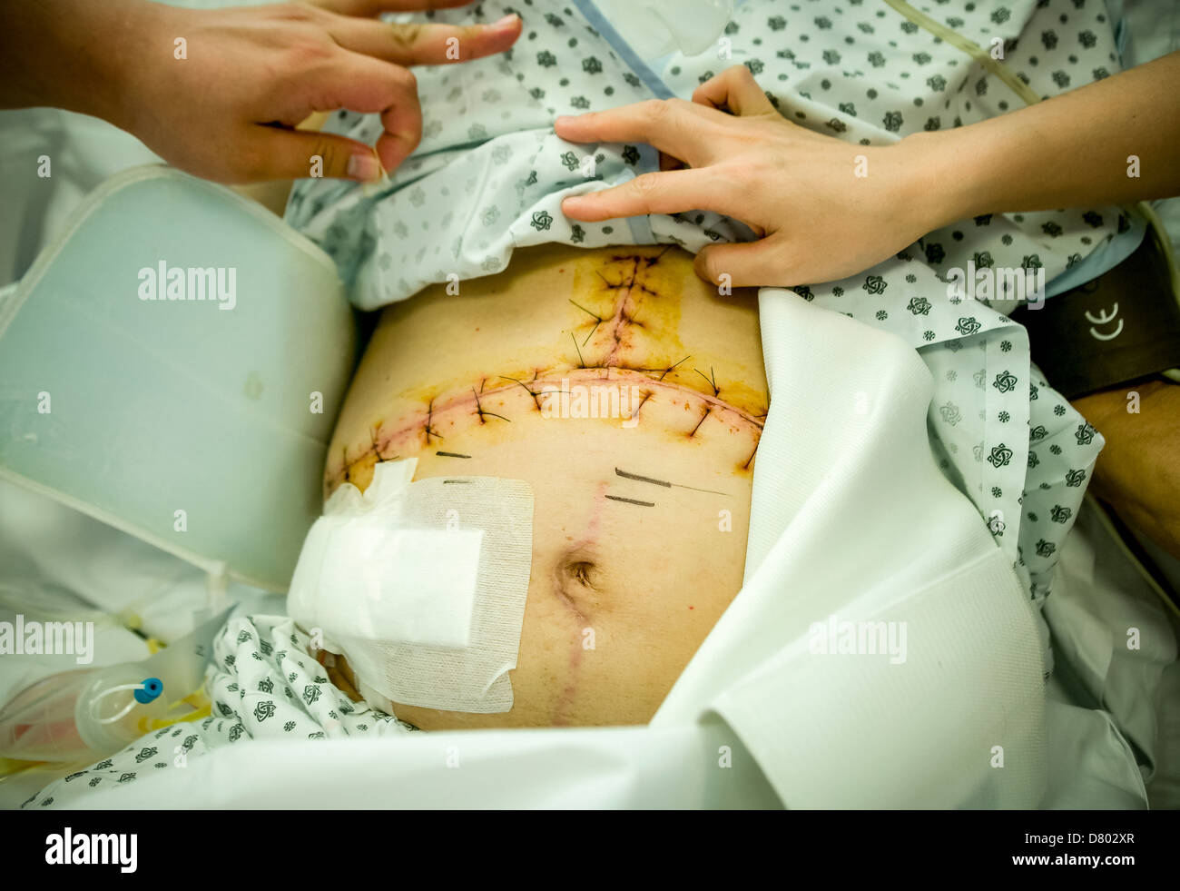 Personal médico atender a un paciente que ha tenido puntos de sutura en la zona abdominal después de la cirugía, en una unidad de cuidados intensivos. Foto de stock