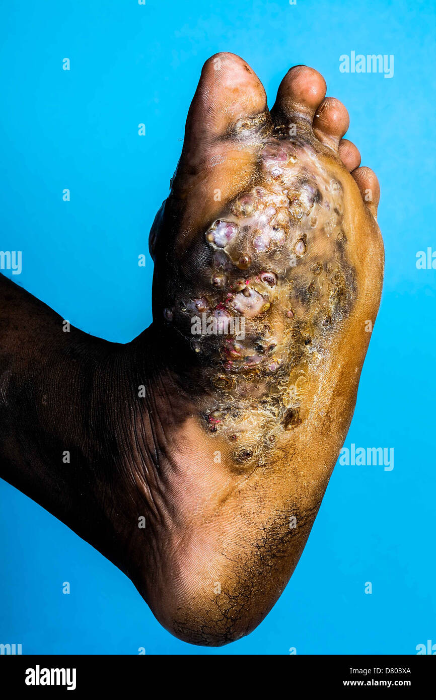 La suela del pie perteneciente a un joven sufre de micetoma. Micetoma es una rara enfermedad que se encuentra en los trópicos. Foto de stock