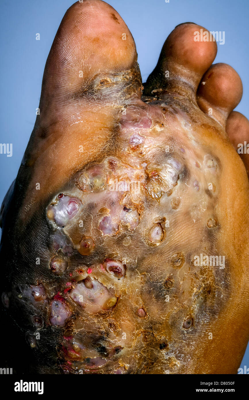 La suela del pie de un joven sufre de micetoma. Foto de stock
