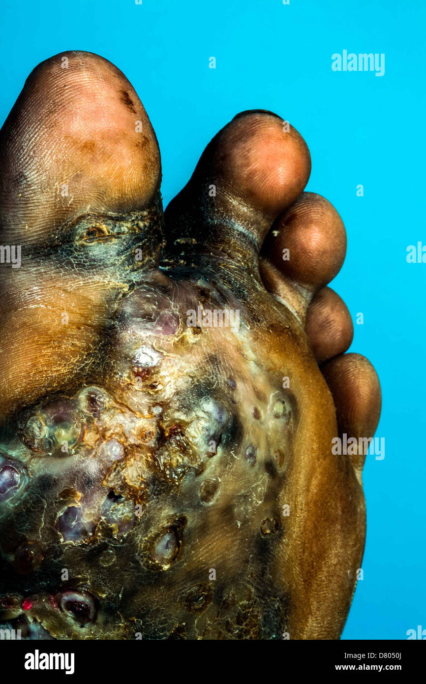 La suela del pie de un joven sufre de micetoma. Foto de stock