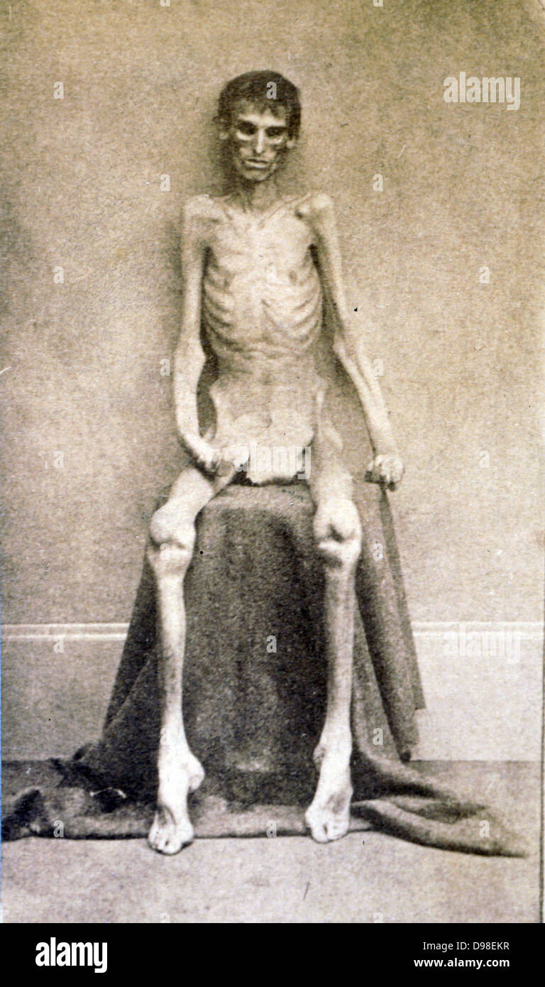 Un preso federal prisión, regresó de la Guerra Civil Americana c 1865 Foto de stock