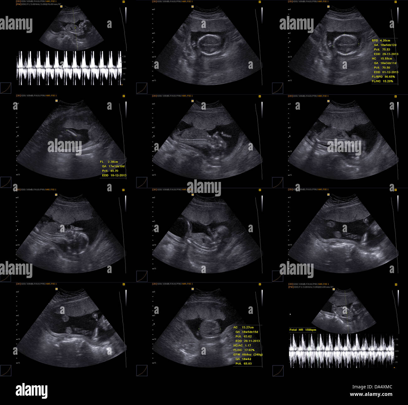 Ultrasonido obstetrico fotografías e imágenes de alta resolución - Alamy