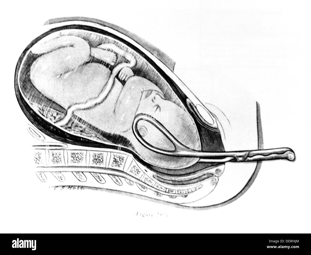 Medicina, nacimiento / ginecología, la recuperación del bebé con