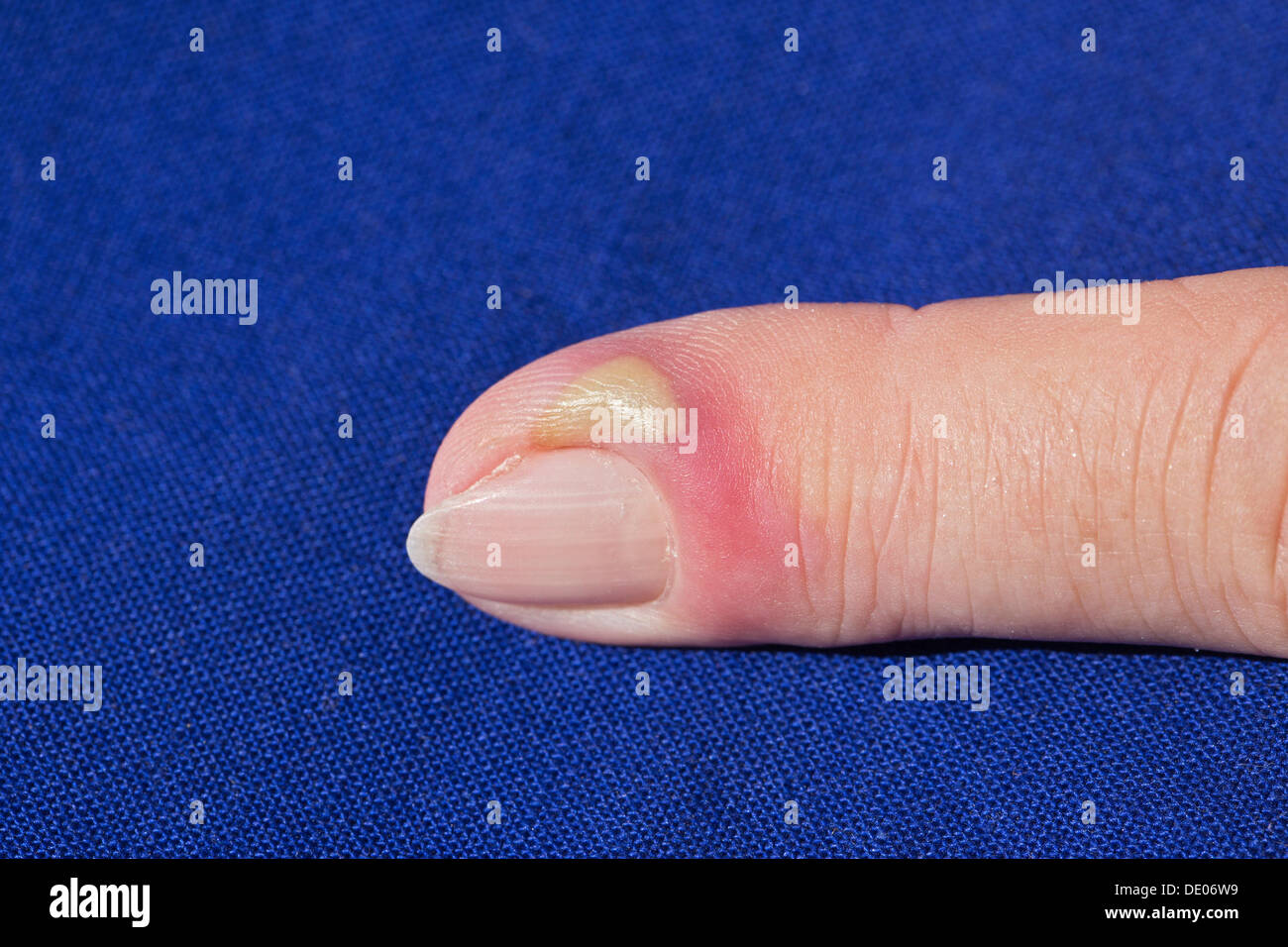 La infección bacteriana, la inflamación, el dedo índice, pus, absceso Foto de stock