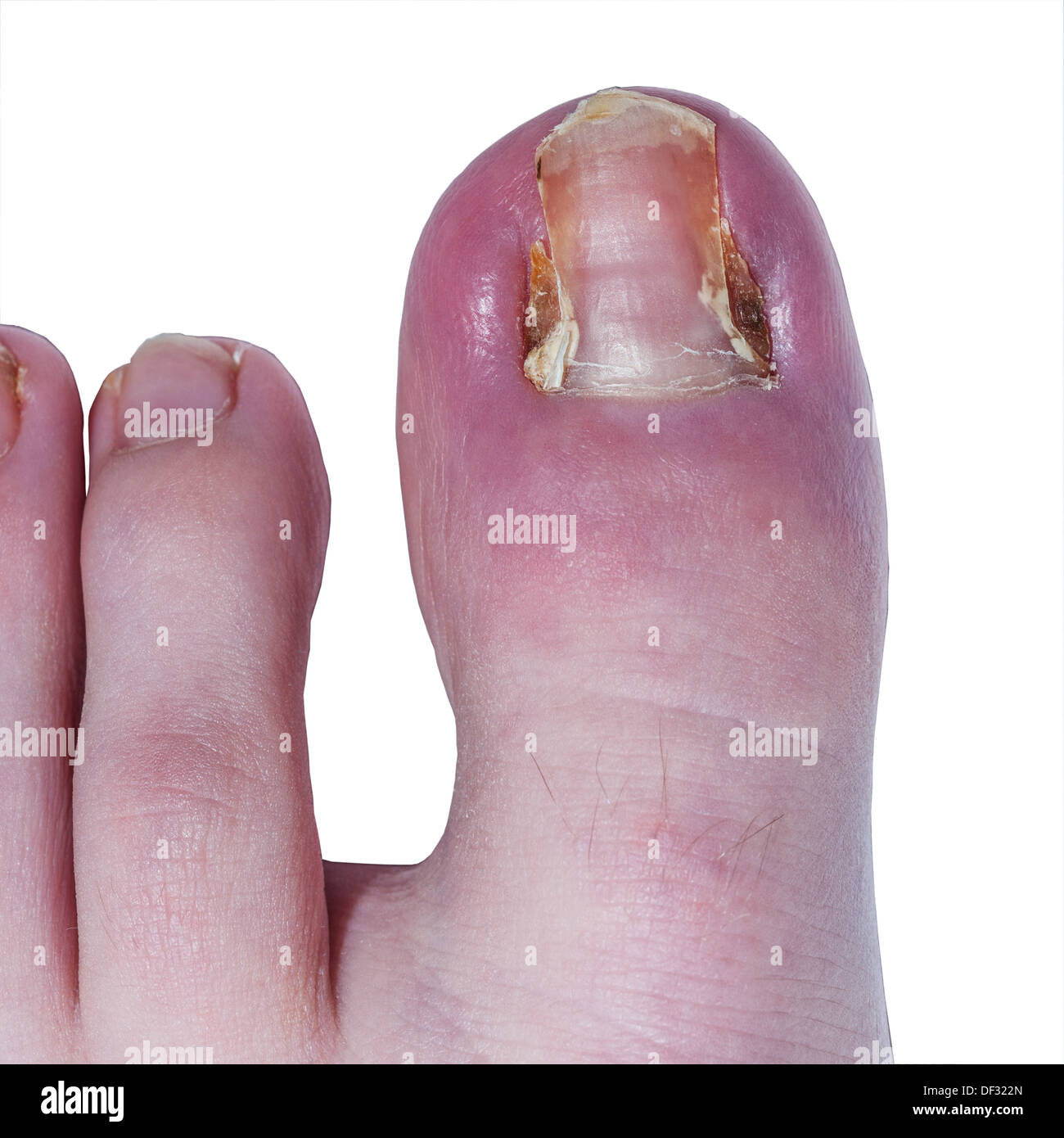 Un childs toe después de cada lado de la uña del dedo del pie debido a un corte de uñas encarnadas Foto de stock