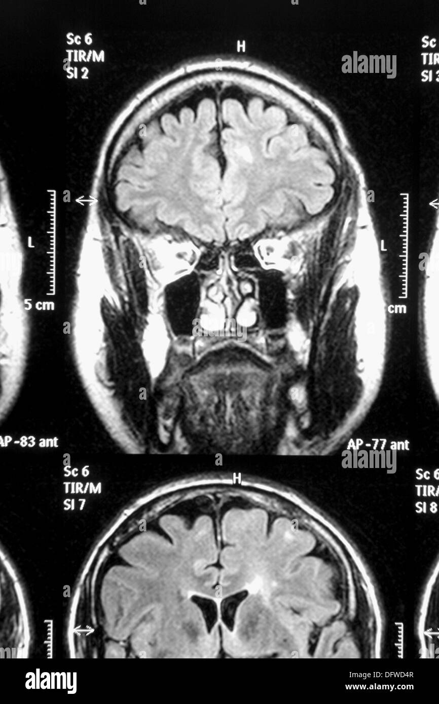 La resonancia magnética del cerebro. Plano coronal Fotografía de stock -  Alamy