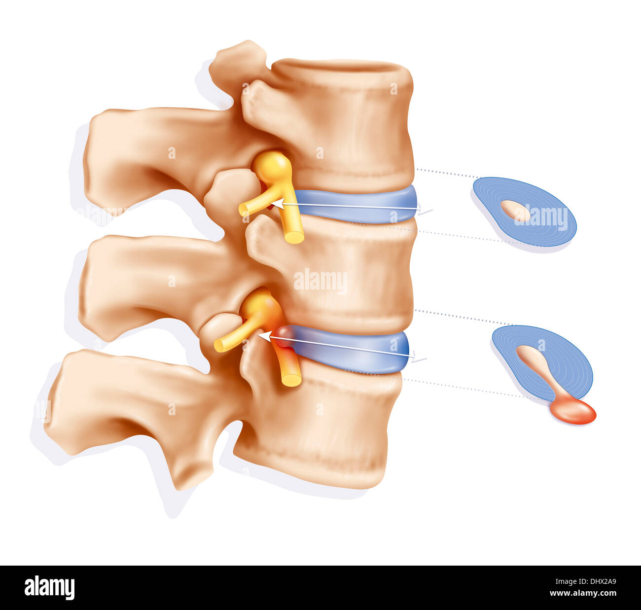 La hernia discal, ilustración Foto de stock