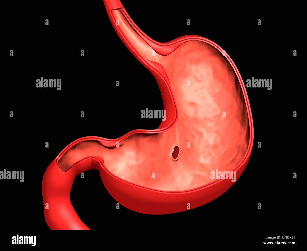 Imagen conceptual de la úlcera péptica en el estómago humano. Foto de stock