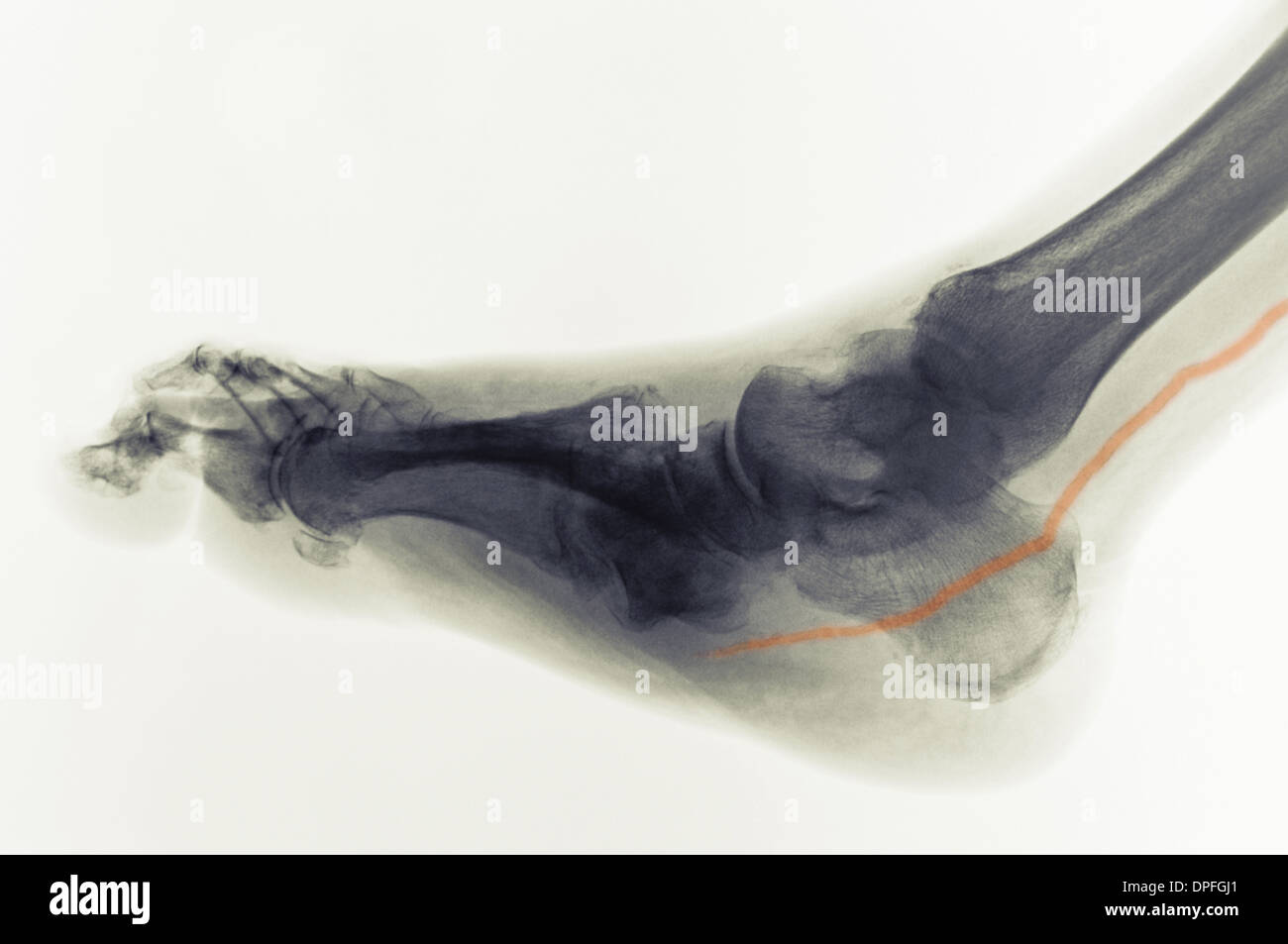 Radiografía del pie del diabético mostrando arteria calcificada Foto de stock