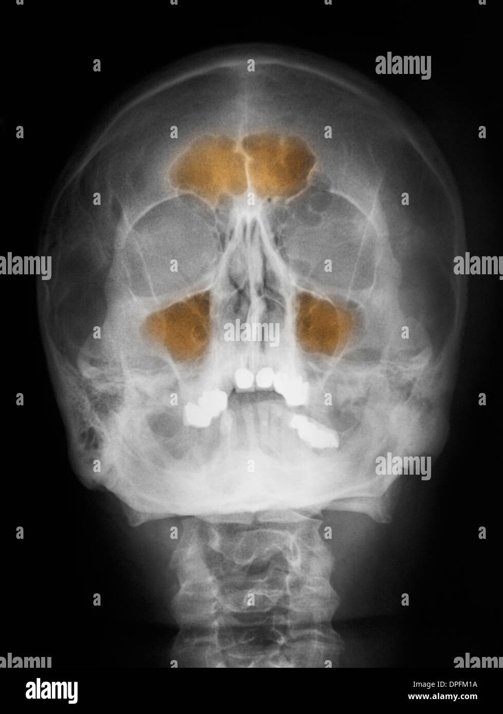 Radiografía de cráneo fotografías e imágenes de alta resolución Alamy
