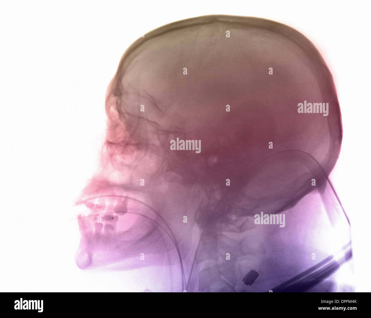 Radiografía del cráneo de un hombre en un accidente de motocicleta Foto de stock