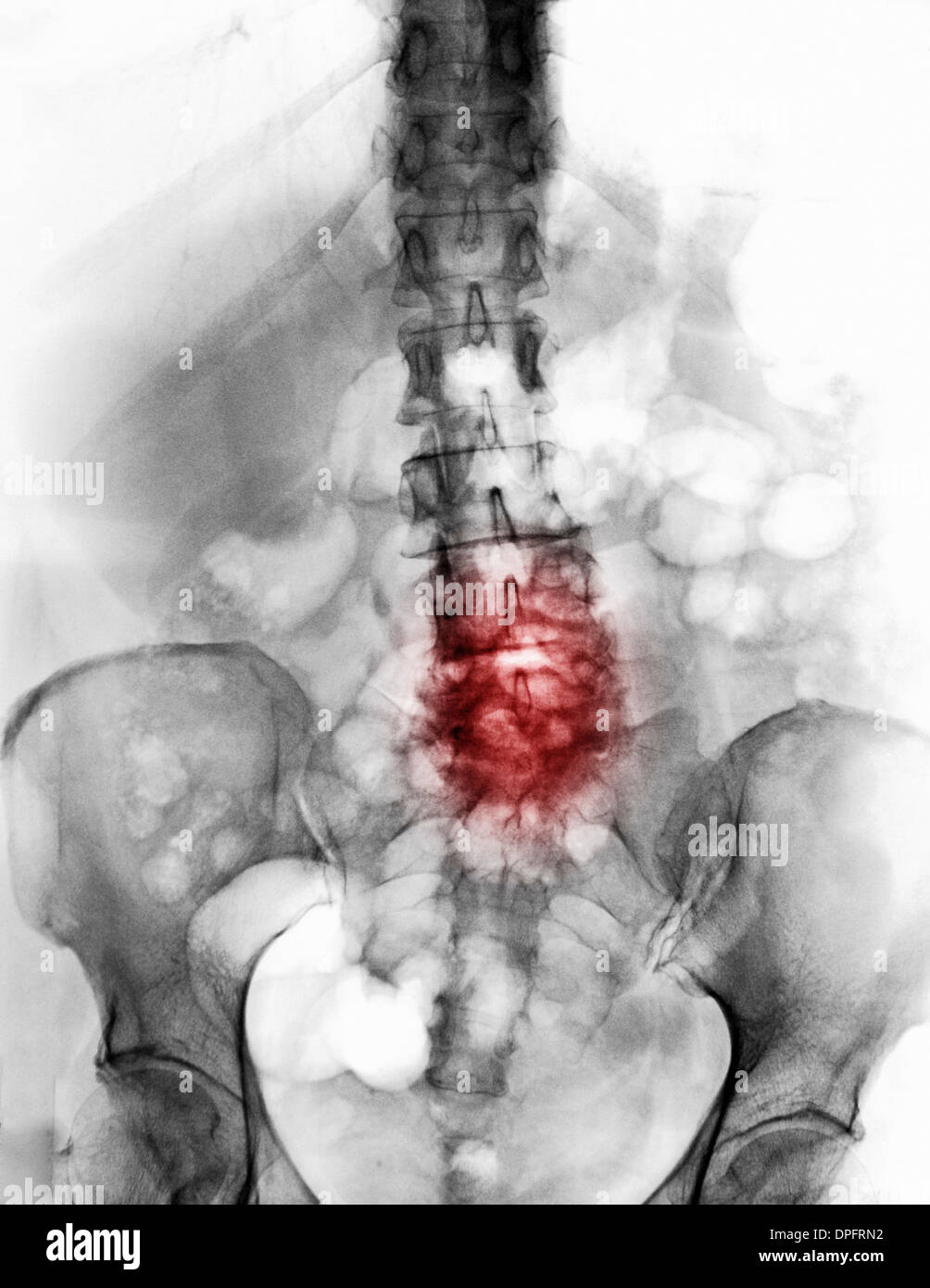 Radiografía de la columna vertebral con cambios artríticos degenerativos Foto de stock