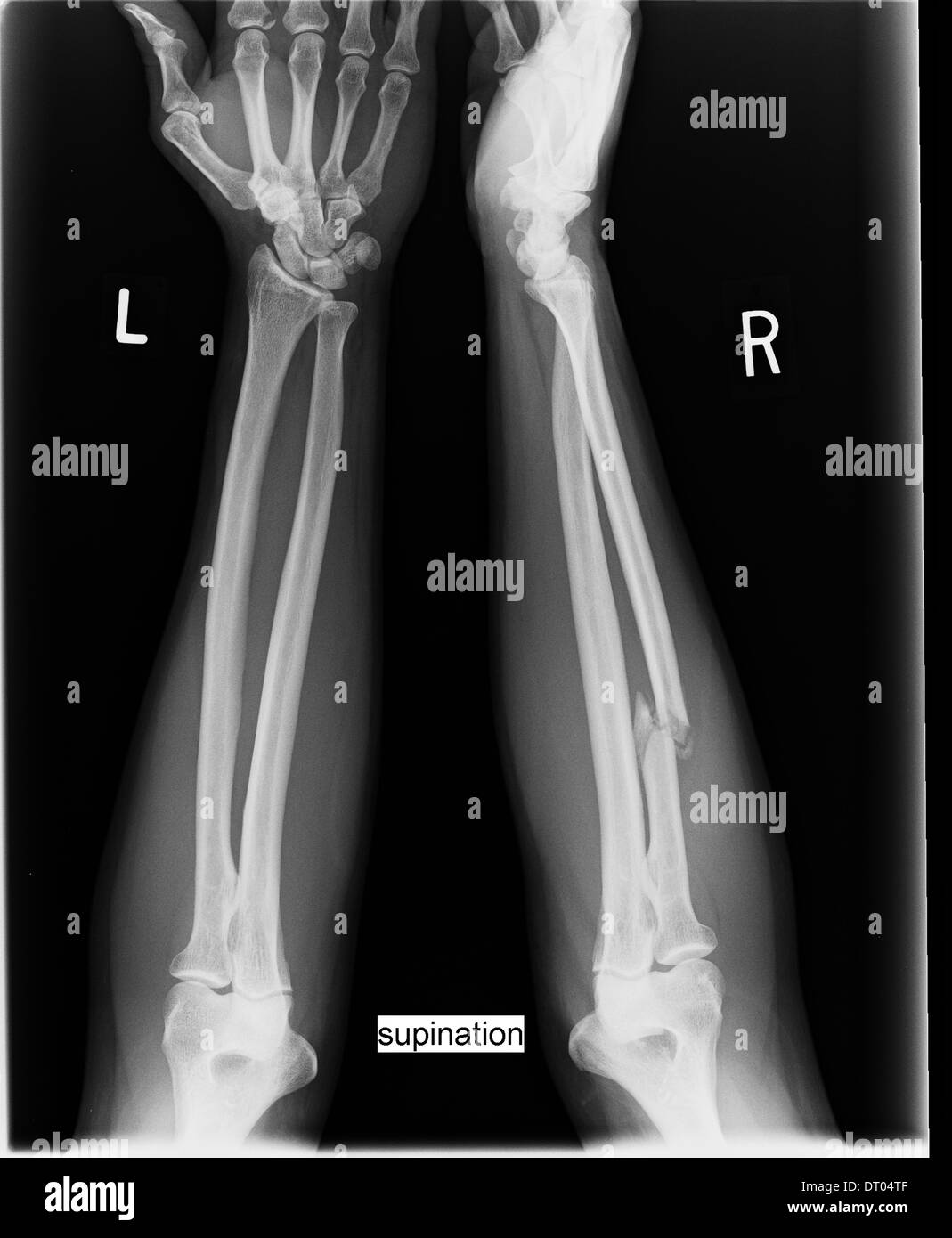 Xknee Startradiology Radiologa Fracturas Rodillas